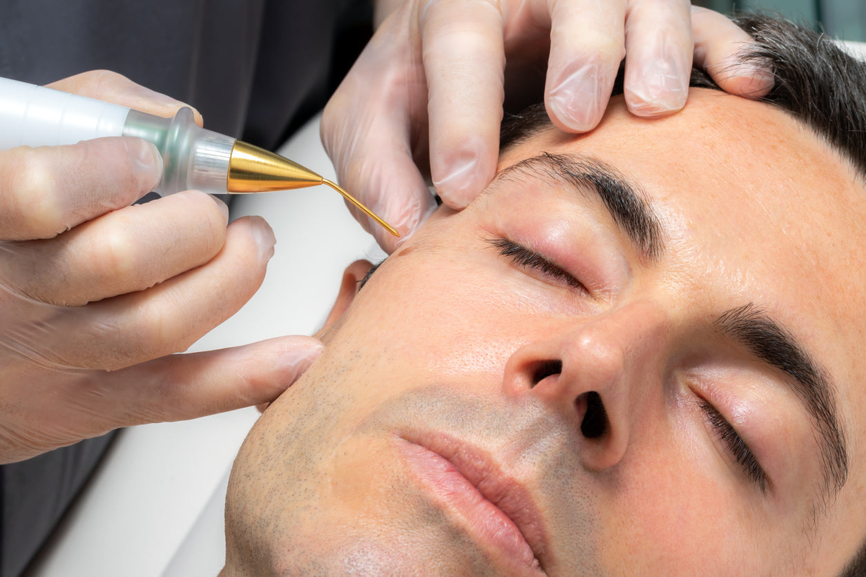 closeup of plasma pen treatment on face